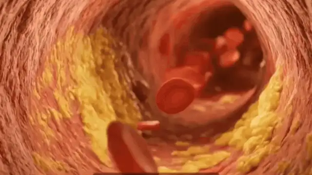 Arterial Flush Recipe: What Does Honey Have to Do With Blood Pressure?